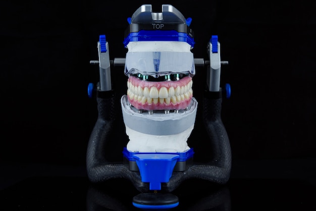 Foto duas próteses dentárias de cerâmica no articulador dentário