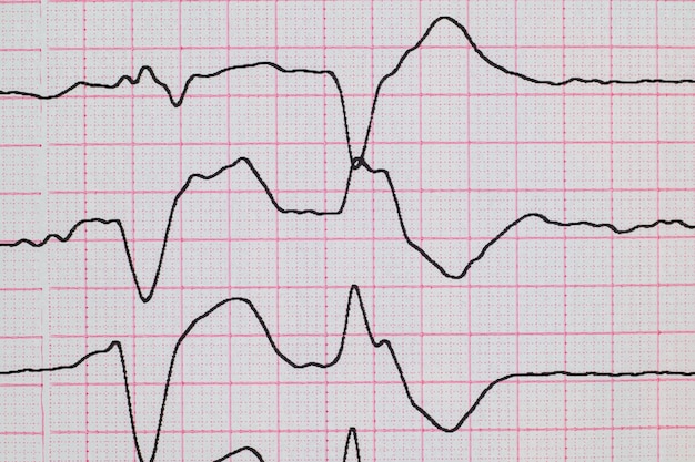 ECG con alteración del ritmo y cierre de extrasístole ventricular