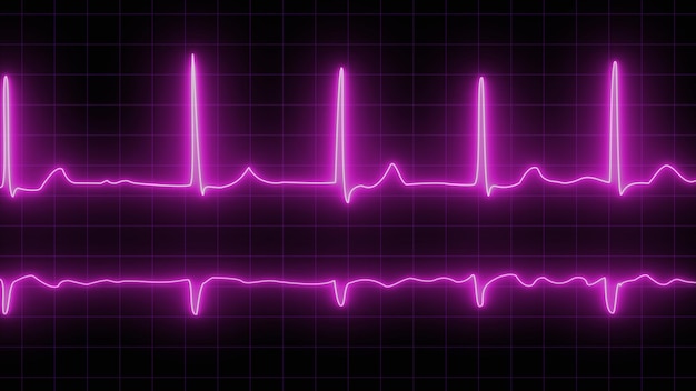 ECG com batimentos supra- ventriculares prematuros e paroxismos curtos de fibrilação atrial neon