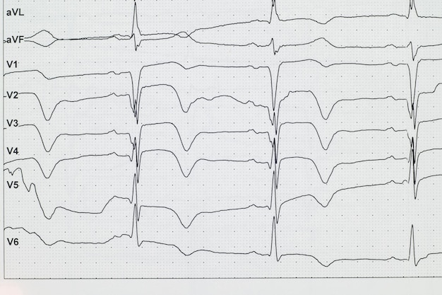 Foto ecg infarto de miocardio en ecg anginadolor en el pecho primer plano