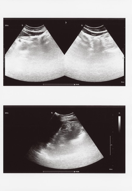 Ecografía de abdomen completo