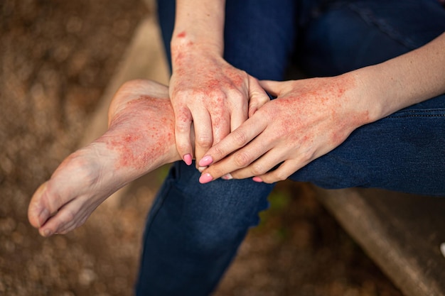 Eczema dermatite nas mãos e pés manchas vermelhas na pele pele seca