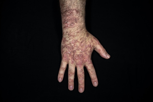 Foto eczema por psoriasis en la mano aislado sobre un fondo negro