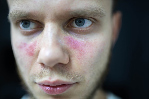 Foto edad manchas de enrojecimiento en la cara un hombre joven está enfermo lupus eritematoso sistémico