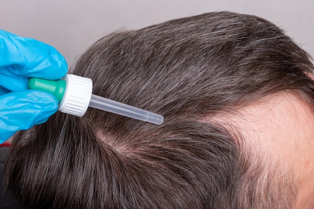 Ein Arzt in blauen medizinischen Handschuhen tropft mit einer Pipettenverstärkungstropfen auf die Haarwurzeln zur Behandlung von männlicher Kahlheit, Nahaufnahme. Behandlung von menschlichem Haarausfall nach Coronovirus.