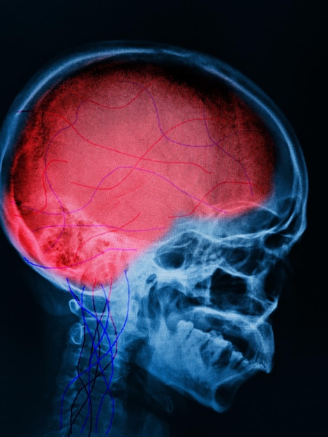 Ein CT-Scan eines menschlichen Kopfes mit einem roten Bereich in der Mitte.