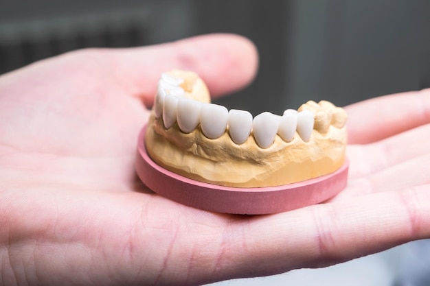 Ein Kiefer mit Keramikzähnen Dentist39s Gerät in der Hand Nahaufnahme