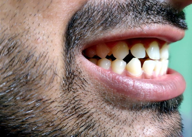 Ein Mann mit Bart zeigt seine Zähne, er hat eine Zahnlücke.