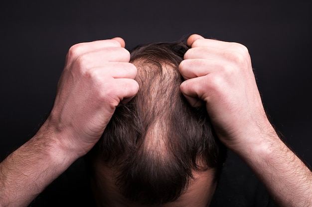 Ein Mann packt seine Haare. Kopf mit Kahlheit. Das Problem des Haarwuchses am Kopf.