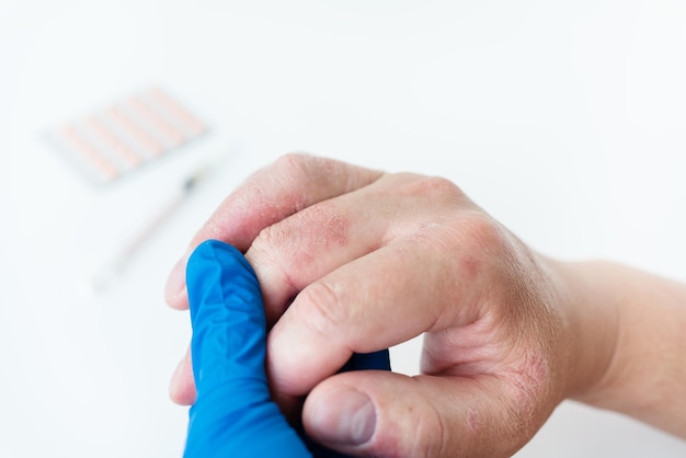 Ein Mann zeigt dem Arzt einen geröteten Ausschlag an den Händen Ursachen für juckende Haut können Dermatitis Ekzem trockene Haut Verbrennungen Nahrungsmittelallergien Gesundheitskonzept sein