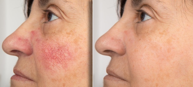 Ein Nahaufnahmeporträt von vor und nach einer reifen Frau, die Rötungen auf ihren Wangen zeigt Das Konzept der Rosacea