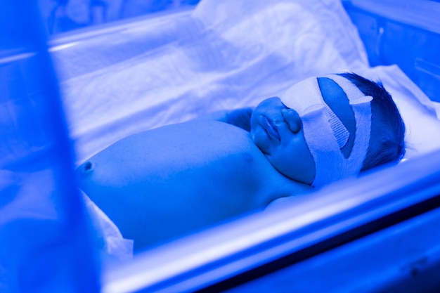 Ein neugeborenes Baby liegt unter UV-Lampen unter blauem Licht Behandlung mit hohem Bilirubin von Gelbsucht bei Kindern UV-Inkubator