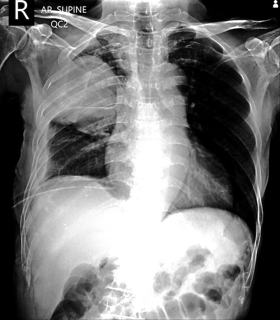 Ein Röntgenbild eines Patienten mit dem Röntgenbild auf der linken Seite.