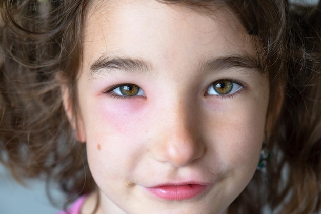 Ein rotes, geschwollenes Augenlid auf dem Gesicht eines Kindes in Nahaufnahme ist eine Allergie gegen einen Insektenstich. Eine allergische Reaktion auf blutsaugende Insekten