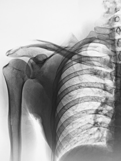 Ein Schwarz-Weiß-Bild einer Schulter mit einem Knochen, der als Schultergelenk gekennzeichnet ist.