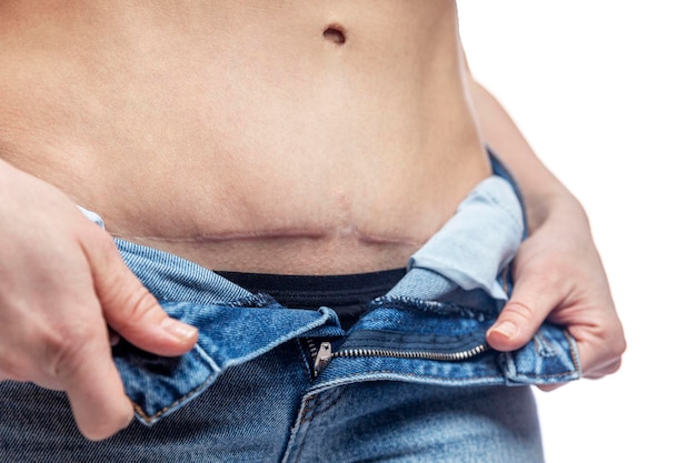 Eine Frau in Jeans zeigt eine große Narbe auf ihrem Bauch Folgen von Kaiserschnitt und Bauchoperation Closeup Weißer Hintergrund