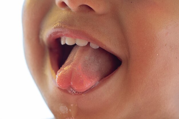Eine Nahaufnahme der Glossophysis der Zunge bei einem Säugling, auch bekannt als Spaltzunge
