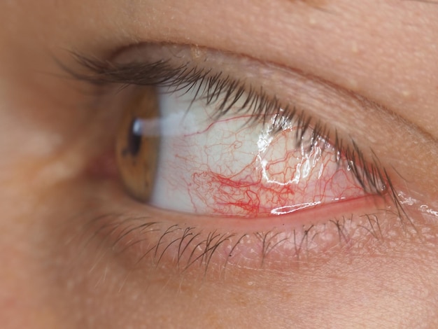 Eine Nahaufnahme des Auges einer Person mit roten Adern