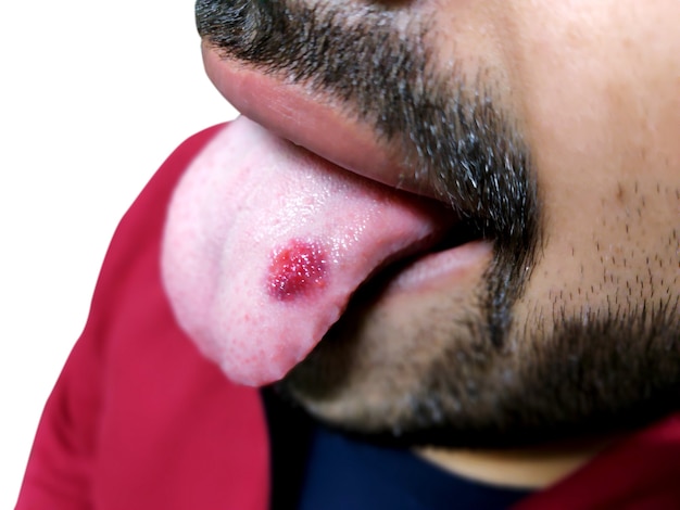 Eine Nahaufnahme einer erkrankten Zunge, in der ein roter Fleck glänzt. Brennen und Beschwerden der Zunge