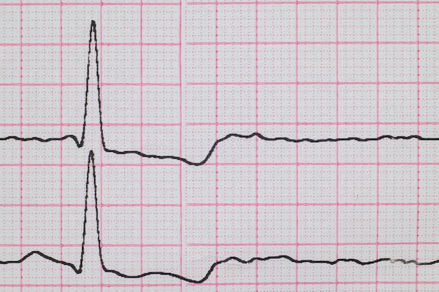 EKG Myokardischämie auf ECGAnginaBrustschmerzen Nahaufnahme