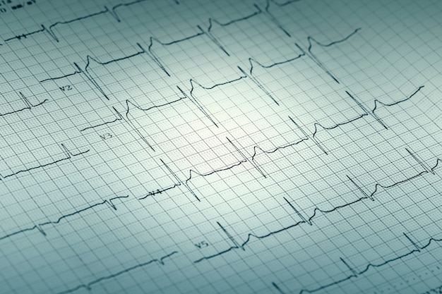 EKG-Papierdiagrammbericht, Elektrokardiogramm auf Papierform als Hintergrund