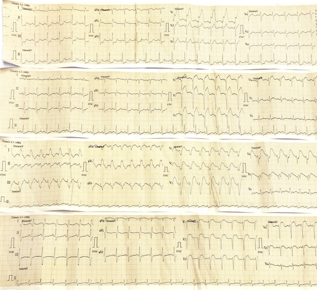 Foto electrocardiógrafo de cerca la imagen como fondo