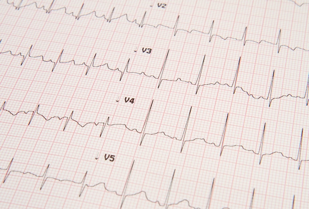 Foto electrocardiograma