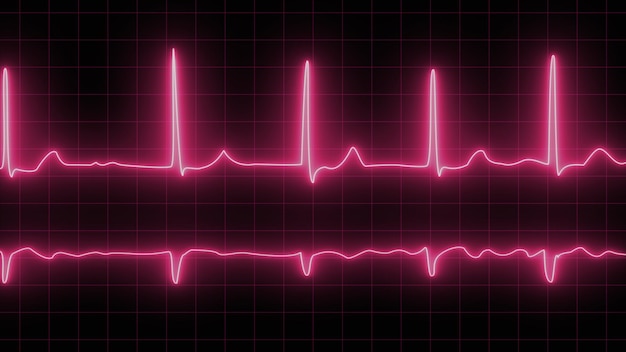 Elektrokardiogramm bei Herzrhythmusstörungen Neon-Atrialfibrillation wurde als Ursache vieler zerebrovaskulärer Unfälle oder Schlaganfälle festgestellt