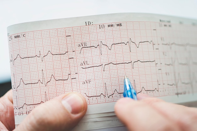 Elektrokardiogramm in den Händen des Arztes. Gesundheitscheck des Herzens.