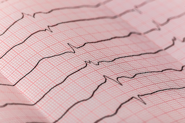 Elektrokardiogramm Interpretation