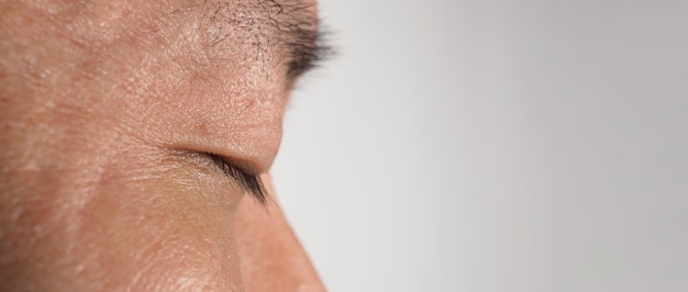 Eliminación de la piel con verrugas Toma macro de verrugas cerca del ojo en la cara Papiloma en la piel alrededor del ojo, la nariz y el cuello Marca de nacimiento Papila o lunar en la piel Crecimiento benigno pequeño y duro en la piel causado por el virus Cuidado de la piel