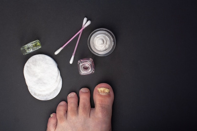 Endecha plana. Hongos en la uña del pie. Herramientas para el cuidado de las uñas afectadas. Crema en un frasco, almohadillas de algodón y bastoncillos de algodón, botellas de líquido. Fondo oscuro.