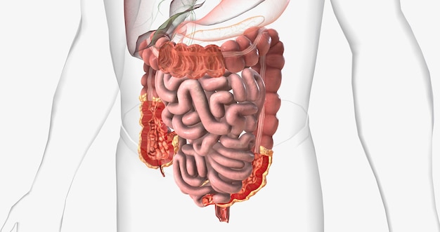 Foto la enfermedad de crohn es un tipo de enfermedad inflamatoria intestinal crónica
