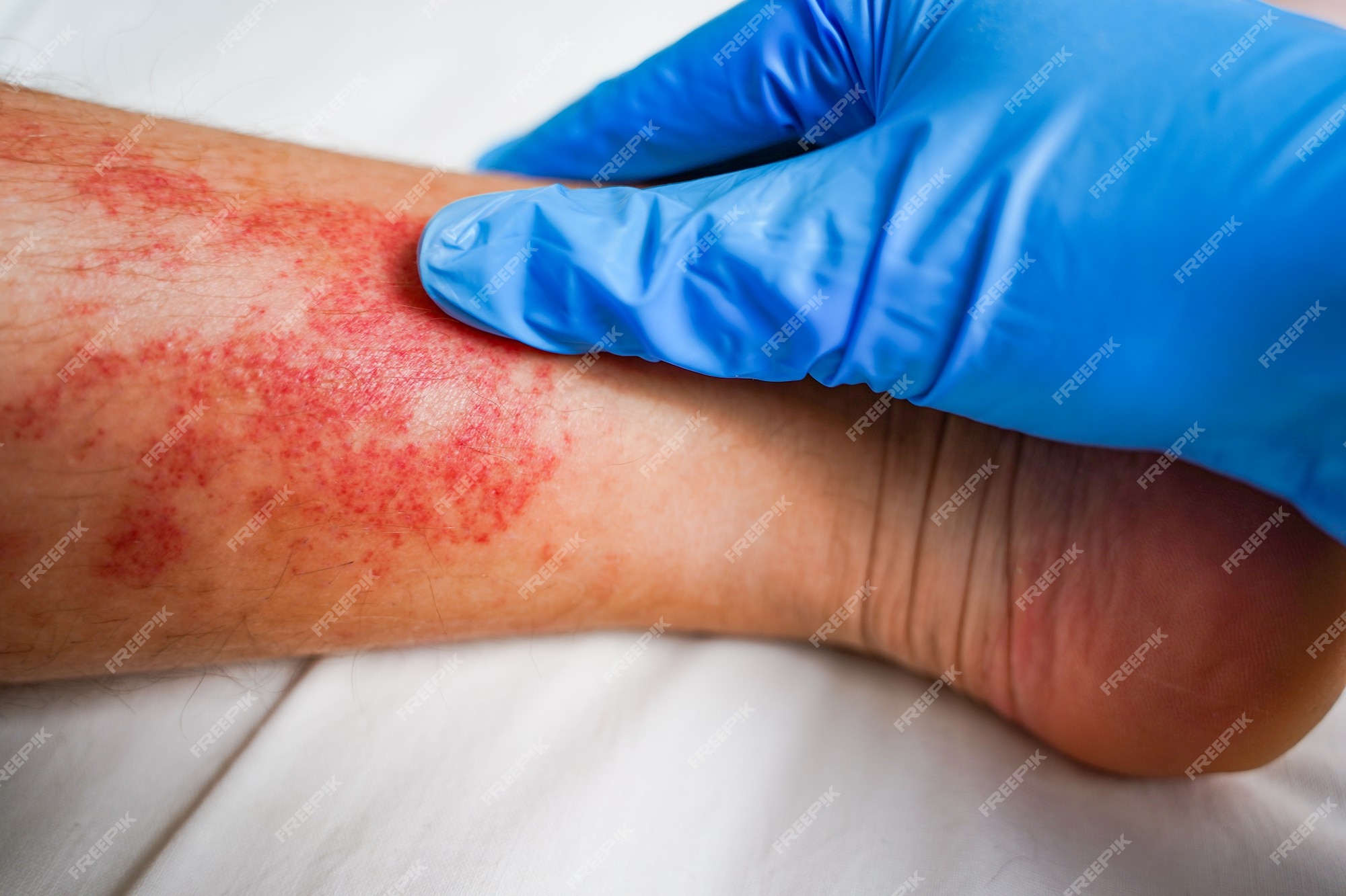 Enfermedad de la piel de las piernas, picazón, y manchas rojas | Foto Premium