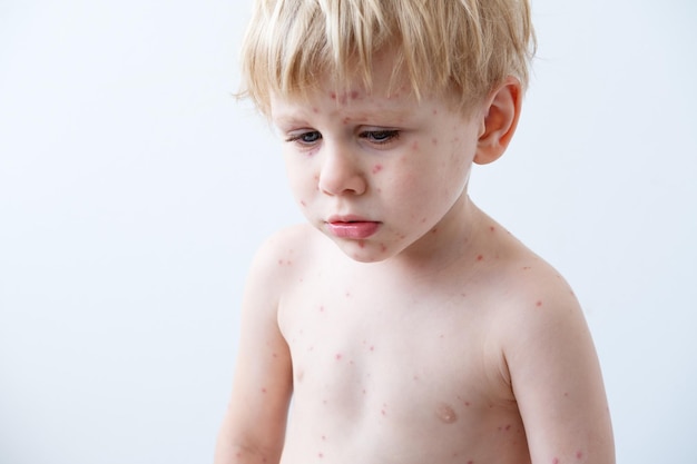 Enfermedad de la varicela, retrato de niño rubio con erupciones rojas Virus de la varicela