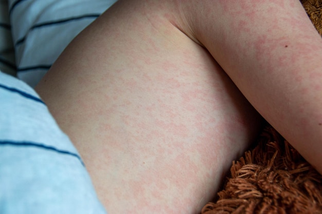 Enfermedad viral Sarampión erupción en el cuerpo del niño Alergia