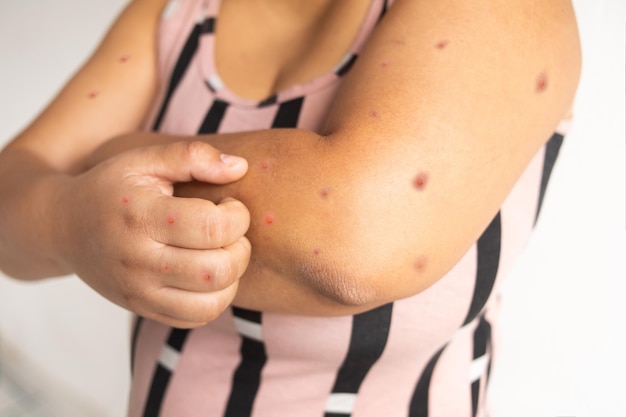 Enfermedad de la viruela del mono. Mujer morena con viruela del mono. Erupción dolorosa, ampollas de puntos rojos en la mano.