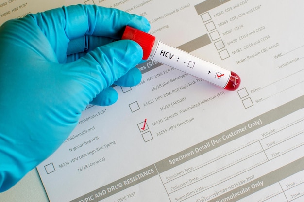 Enfermedades de transmisión sexual VHC