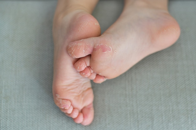 Enterovirus pie mano boca Piel desprendida de las piernas de un niño Virus Cocksackie