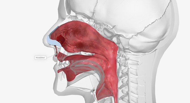 La epistaxis es una hemorragia nasal causada por una lesión o que aparece espontáneamente.