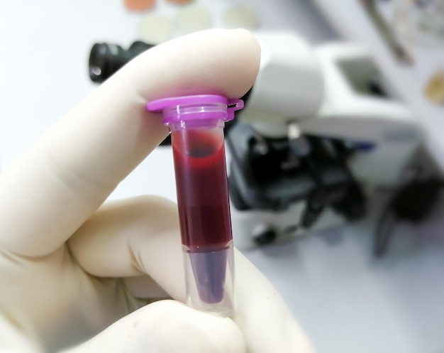 Eppendorf con muestra de sangre para análisis médicos