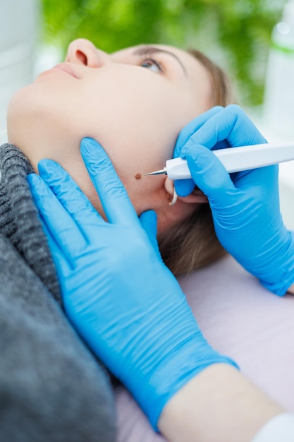 Foto equipamento médico moderno para a remoção de neoplasias na superfície da pele remoção de uma marca de nascimento no rosto