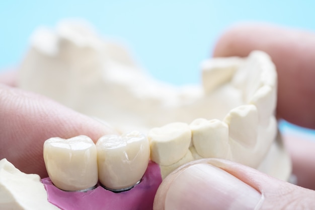Equipo de odontología de implantes de primer plano / implante o prótesis / implantes de coronas y puentes dentales y modelo de restauración de reparación rápida.