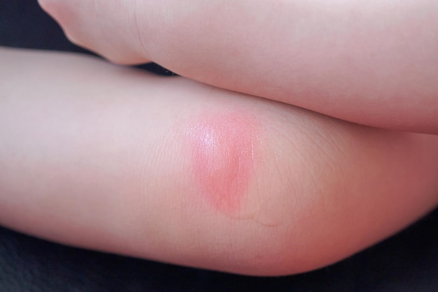 Erupção cutânea e alergia do bebê com mancha vermelha causada por picada de mosquito no joelho