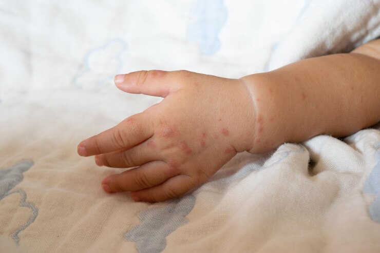 Foto erupção cutânea vermelha causada por infecção da boca e da boca nos braços dos lactentes