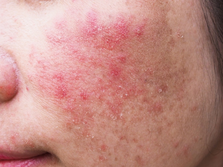 Foto erupção cutânea vermelha no rosto de mulher jovem, problemas de pele alérgicos e com coceira, dermatite