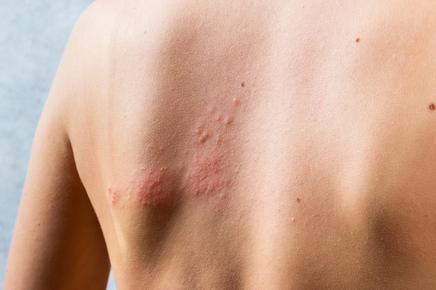 Erupção de varicela. Telhas, vírus varicela-zoster. erupção cutânea e bolhas no corpo. Vírus Herpes zoster infectado na pele. Vírus do herpes no corpo. erupção de urticária. dermatite atópica