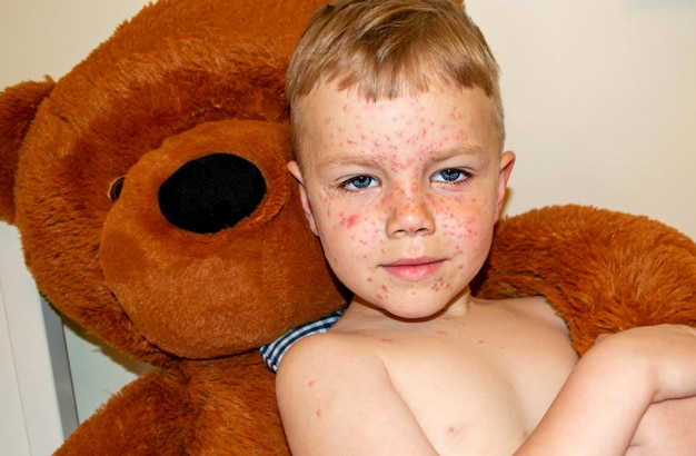 Erupción de burbujas por el virus de la varicela o la varicela en el niño