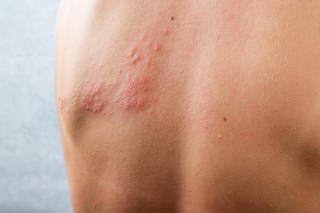 Erupción de varicela. Herpes zóster, virus varicela-zoster. erupción cutánea y ampollas en el cuerpo. Herpes zóster infectado por la piel. Virus del herpes en el cuerpo. erupción de urticaria. dermatitis atópica