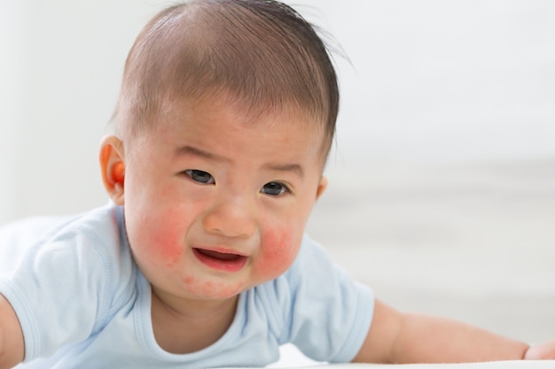 Erupciones cutáneas en concepto de bebés